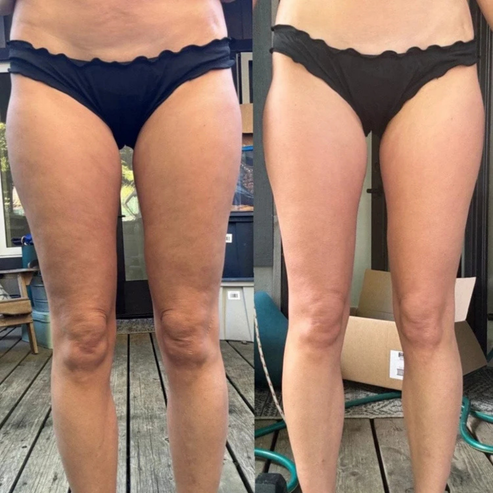 Mirova™ - Cellulite Massager